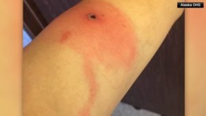 Variola Do Alasca.jpeg