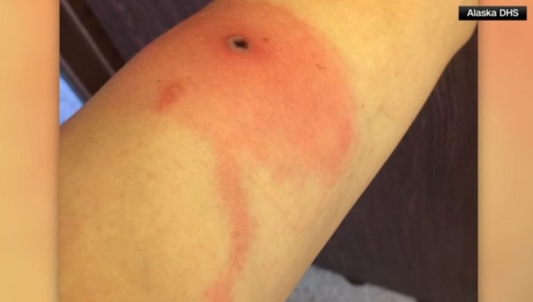 Variola Do Alasca.jpeg