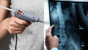 Cientistas criam "pistola de cola" que imprime enxerto ósseo direto na fratura