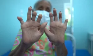 Filhos separados de vítimas de hanseníase têm cinco anos para pedir indenização, decide STF